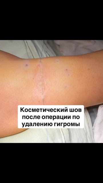 Косметический шов/Гигрома