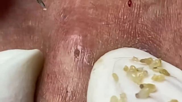 Выдавливание прыщей, угрей, черных точек и камедонов #127 смотреть онлайн