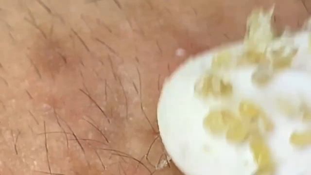 Выдавливание прыщей, угрей, черных точек и камедонов #130 смотреть онлайн