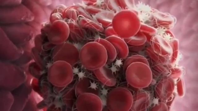 Образование тромба смотреть онлайн