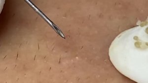 Выдавливание прыщей, угрей, черных точек и камедонов #128