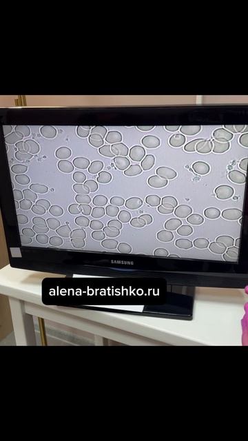 Тревожность сонливость нет сил - это признаки низкого гемоглобина. Семейный доктор Алена Братишко