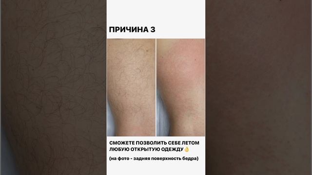5 причин сделать #электроэпиляцию