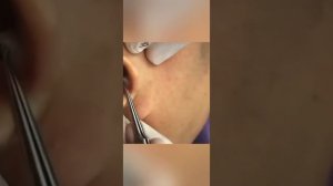 ЧЕРНЫЕ ТОЧКИ В УХЕ