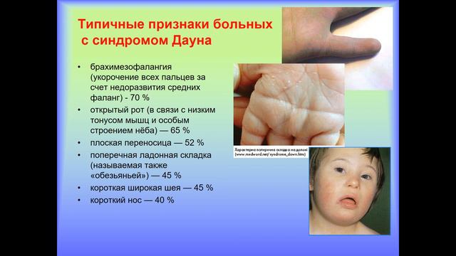 Хромосомные заболевания,связанные с изменением количества хромосом.