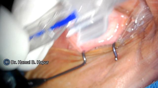 LUX SMART PRELOADED IOL Simple Implantation technique - Dr Kamal B Kapur