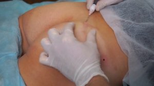 Моделирование ягодиц с применением препарата на основе полимолочной кислоты Gana X Ярослав Лата