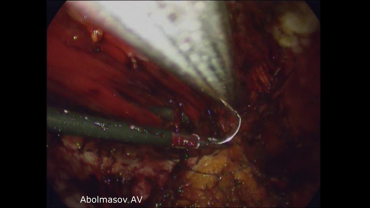 laparoscopic eTeP RS diastasis recti correction смотреть онлайн