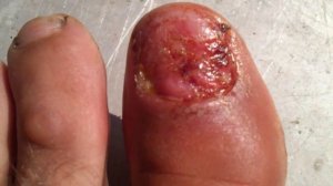 Палец без ногтя