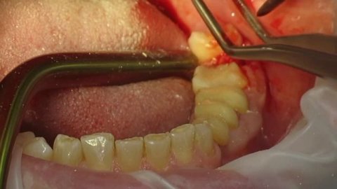 Удаление зуба мудрости с распиливанием корней.