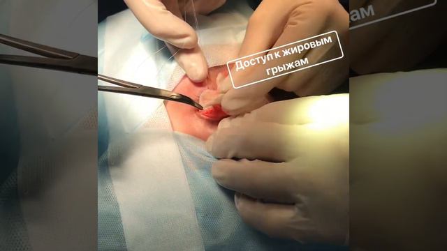 Трансконъюнктивальная блефаропластика смотреть онлайн