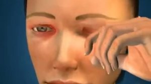 Блефарит - что это такое