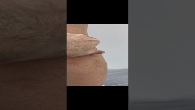 Варикоз на ногах. Рецидив варикоза. Как лечить варикоз? Лечение варикоза. Флеболог Москва. Флеболог смотреть онлайн