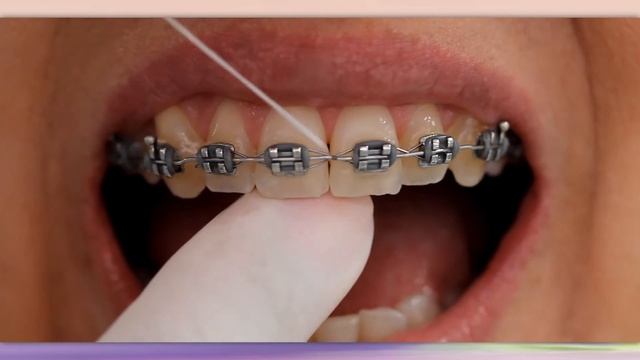 How to use a floss threader or Superfloss смотреть онлайн