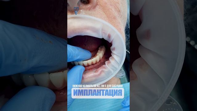 Нижняя челюсть на all on 6 для бабушки. Lower jaw on all on 6 for grandma. #dentist