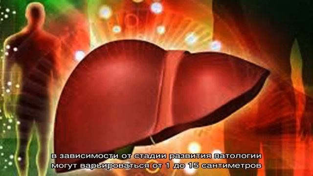 Что такое фокальная нодулярная гиперплазия печени смотреть онлайн
