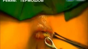 геморроидэктомия с использованием технологии ТЕРМОШОВ