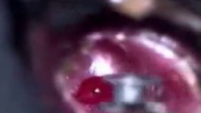 Миринготомия с шунтированием.mp4 смотреть онлайн