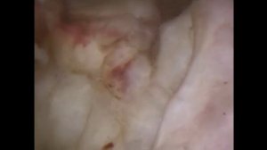 гистерорезектоскопия миомэктомия, узел G1 с локализацией в перешейке