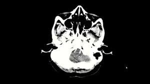Falx meningioma: MRI brain