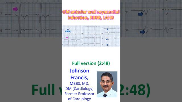 Old anterior wall myocardial infarction, RBBB, LAHB