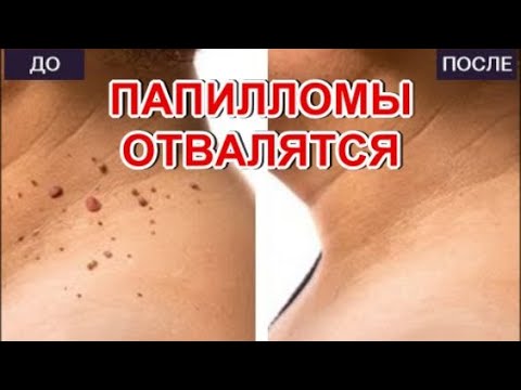 Папилломы Отвалятся!Простые методы удаления ПАПИЛЛОМ в домашних условиях. смотреть онлайн