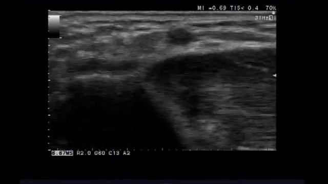 Тромбоз подкожных вен верхней конечности смотреть онлайн