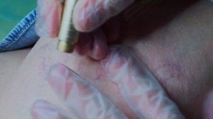 Удаление Сосудов на Ногах