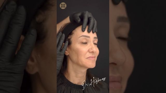 3Q Surgery | عملية رفع الجزء العلوي من الوجه بالمنظار و ازالة الجفن السفلي مع الدكتور فراس حمدان смотреть онлайн