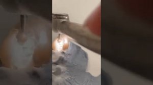 Острая боль! Удаление зуба с кистой!