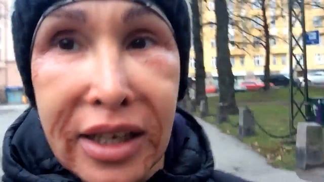 О том как я убирала морщины пол глазами продолжение, реабилитация 16, 2017 смотреть онлайн