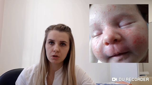 Акне новорожденных! Сыпь у новорожденного ребенка?