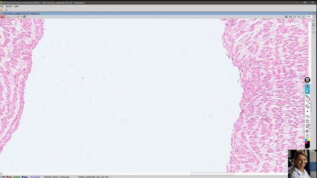 funiculus umbilicalis (pupečník) смотреть онлайн