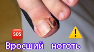Вросший ноготь?⚠️❗️??