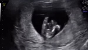 Первый вдох новорожденного: механизм