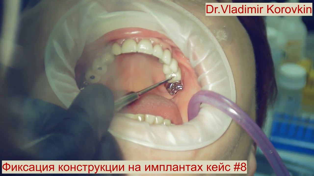 Фиксация консольной конструкции(металлокерамика) на имплантах 15,14,25 .Кейс #8