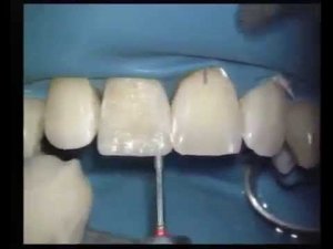 Реставрация зубов