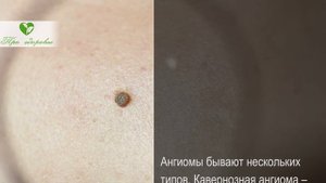 Опасность красных родинок!? Что делать и нужно ли лечить ангиомы?
