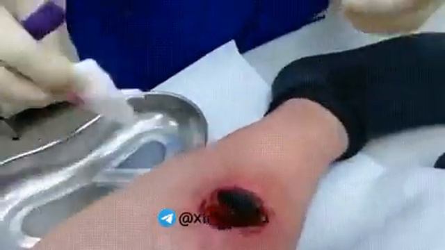 To'qima nekrozi | некроз тканей смотреть онлайн