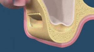 Закрытый синус лифтинг