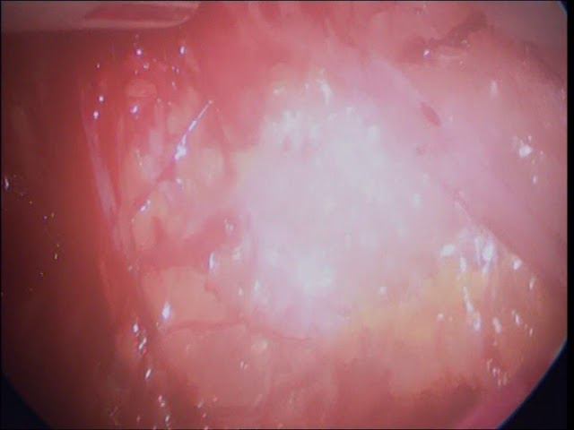 laparoscopic TEP full time video -17 min смотреть онлайн