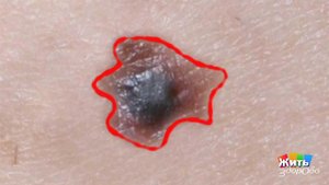 Родинки и солнце. Жить здорово! Фрагмент выпуска от 16.05.2018