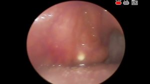#Tonsil #stone Камень правой небной #миндалины удаление и лечение в КЛИНИКА ОБРАЗЦОВА ЛОР врач