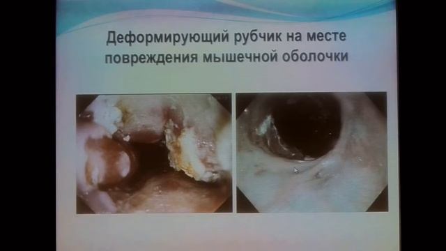 03Новиков ВН Пищевод Барретта Современная эндохирургическая коррекция смотреть онлайн