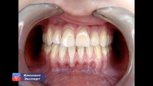 Интересные факты о золотых коронках, которые стоит знать