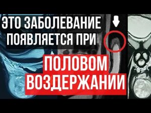 ЗАБОЛЕВАНИЕ которое ПОЯВЛЯЕТСЯ  после ПОЛОВОГО ВОЗДЕРЖАНИЯ