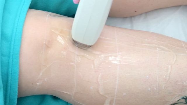 Диодный лазер EPIL LASER 808 - Lasertech
