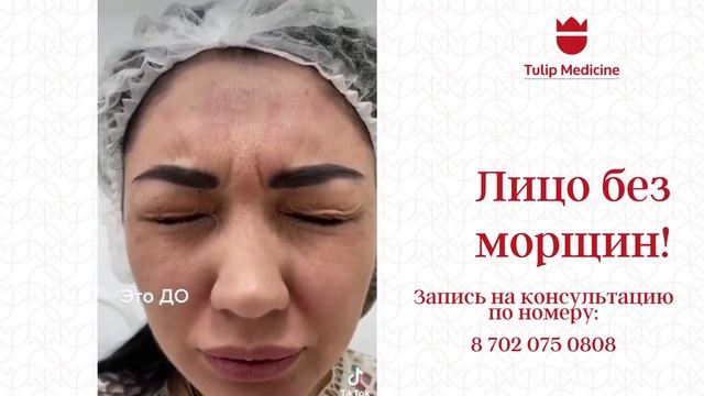 Устранение мимических морщин!