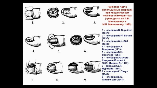 Лекция - Вросший ноготь (2007)