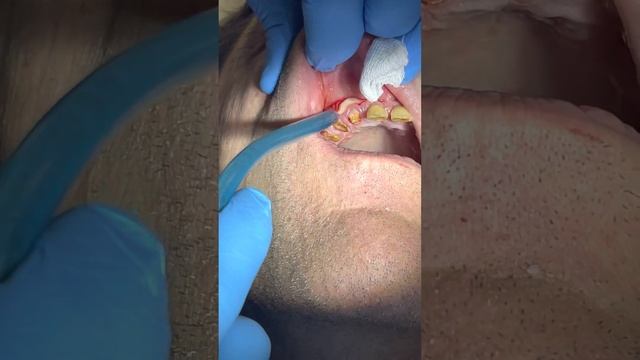 Гнойный острый периостит ! Слабонервным не смотреть ) смотреть онлайн